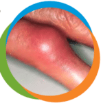 finger-gout-1