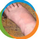 foot-gout-2