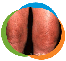 knee-gout-1