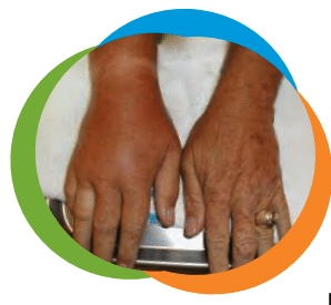 wrist-gout-1